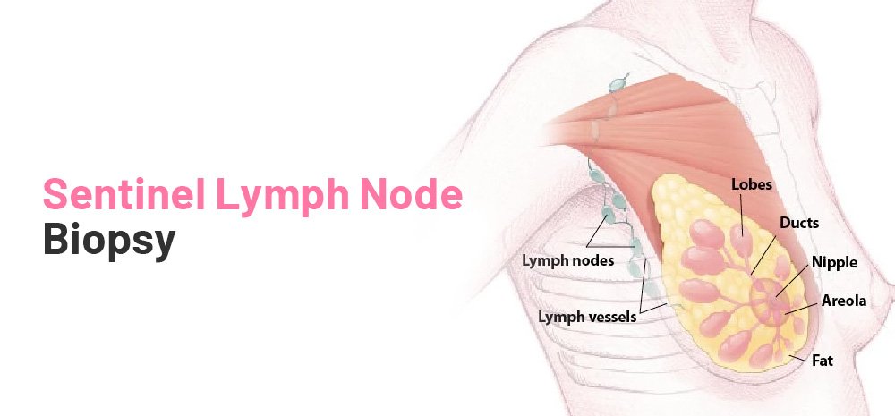 Sentinel Lymph Node Biopsy